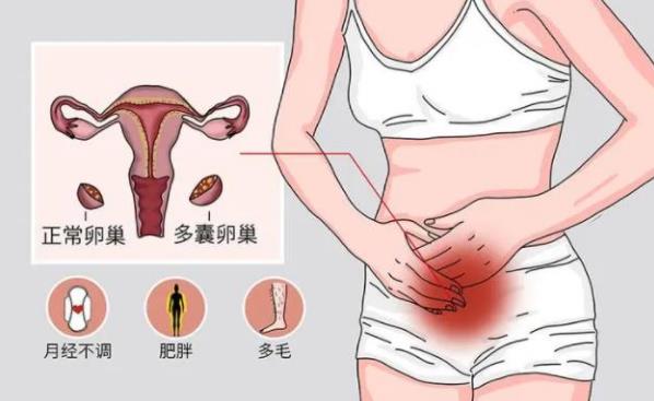多囊卵巢综合征是什么